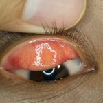 Santé, épidémie de conjonctivite dans l’archipel